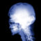 Skull Implants X Ray Backgrounds For Powerpoint – Health And Throughout Radiology Powerpoint Template
